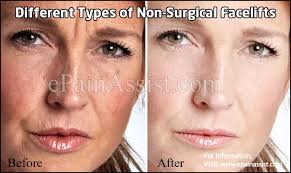 What is a Nonsurgical Face Lift?