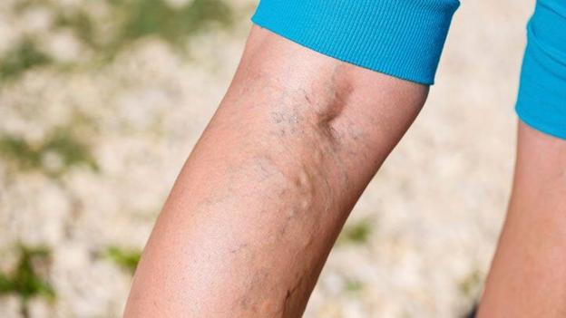 Vein Center Doctor Diana Wilsher, D.O. Explains Benefits of Sclerotherapy for Varicose Vein Treatment