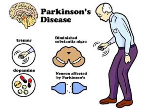 Is Parkinson’s Disease fatal? Its Cause, Symptoms, and Treatment!