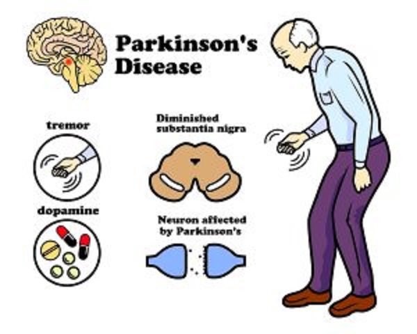 Is Parkinson’s Disease fatal? Its Cause, Symptoms, and Treatment!